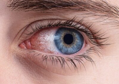 dry eye syndrome