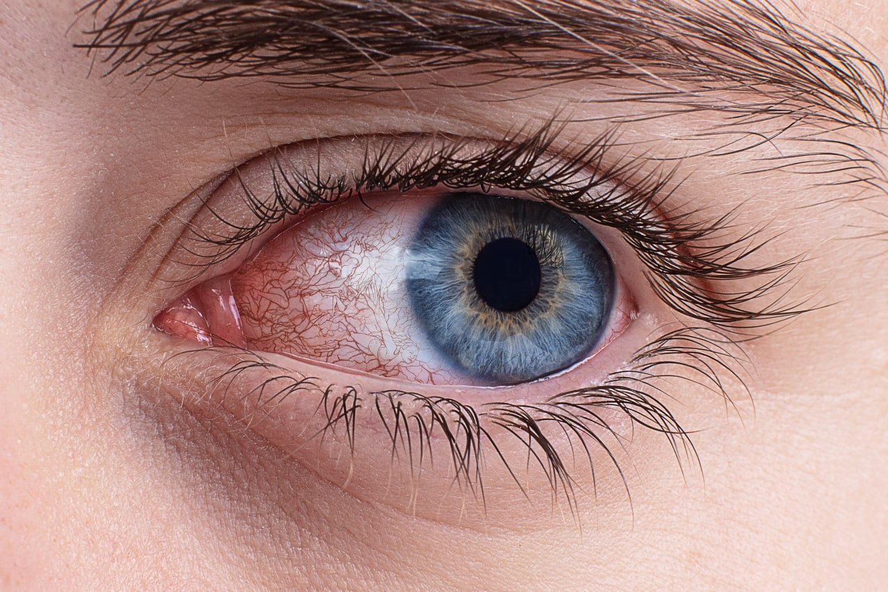 dry eye syndrome